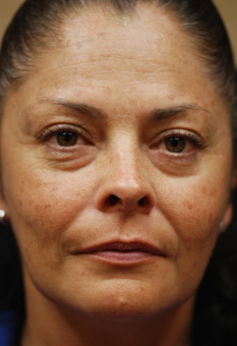 Sculptra Aesthetic