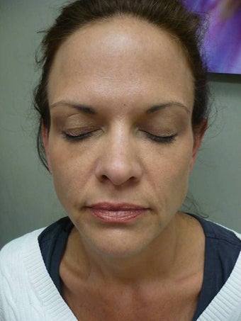 Sculptra