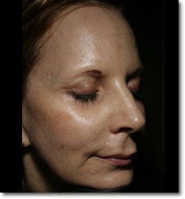 Sculptra 