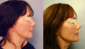 Sculptra treatments
