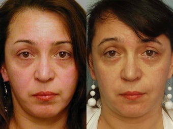 Two vials Sculptra