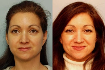 Sculptra treatment for cheeks