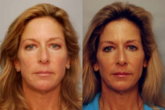 Sculptra to cheek areas