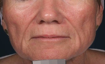 Fillers - Sculptra