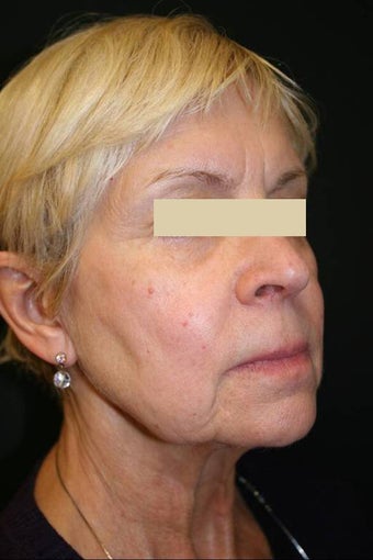 Sculptra 