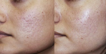 Acne scar