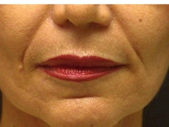 Sculptra