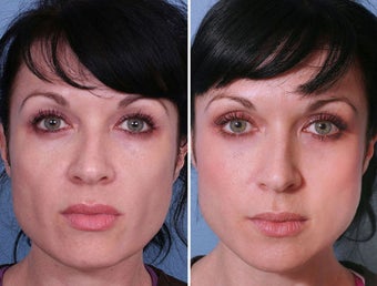 Sculptra Filler in Cheek Hollows
