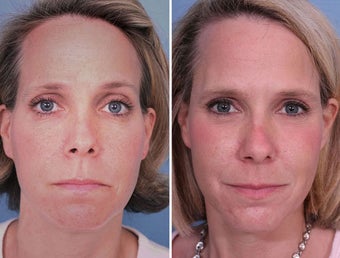 Sculptra filler in Cheeks and Temples