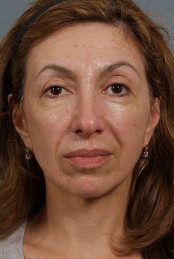Sculptra 