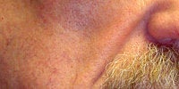 Sculptra