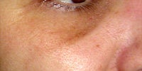 Sculptra