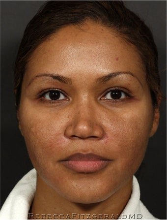 Sculptra & eMatrix