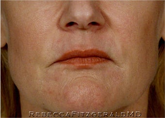 Sculptra, Botox, Juvederm and Restylane