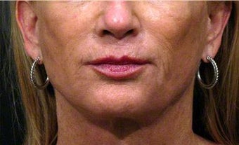 Sculptra, Juvederm, Obagi