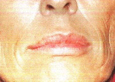 Sculptra