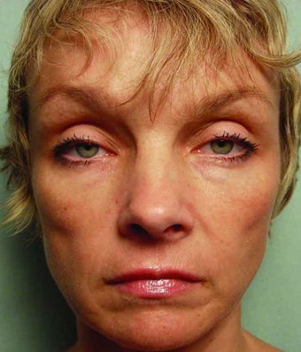 Liquid Facelift