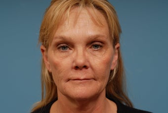 Sculptra, Restylane