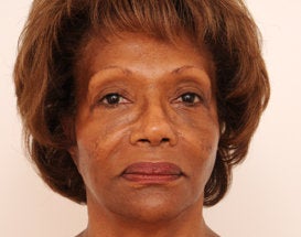Sculptra Injection:  3 Vials to Midface and Jowls