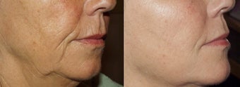 Sculptra