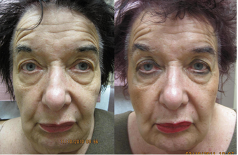 Sculptra facial rejuvenation