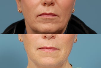 Sculptra  area around mouth