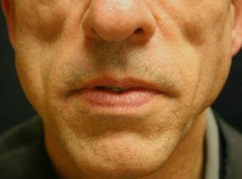 Sculptra
