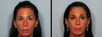 Sculptra