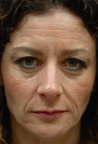 Sculptra Aesthetic