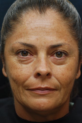 Sculptra Aesthetic