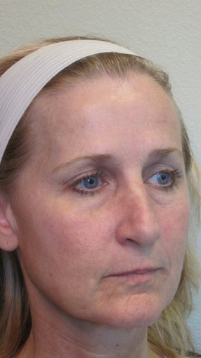 Sculptra and juvederm
