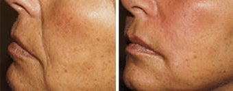 Sculptra for facial wrinkles