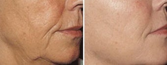 Sculptra for wrinkles around the mouth