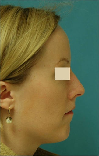Rhinoplasty, Septoplasty