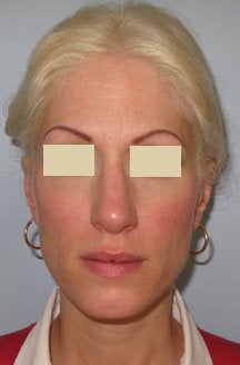 Rhinoplasty and Septoplasty