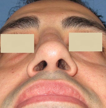 Rhinoplasty, Septoplasty