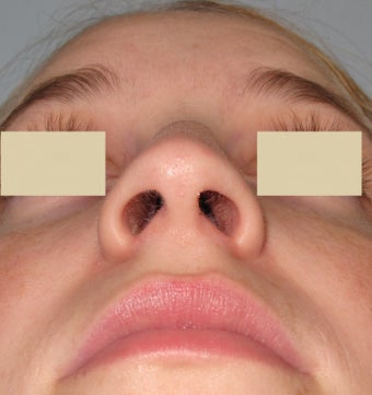 Rhinoplasty and Septoplasty