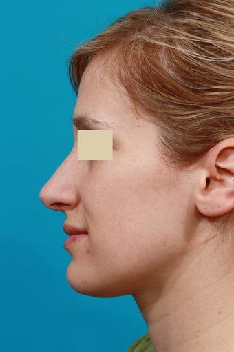 Open Septorhinoplasty