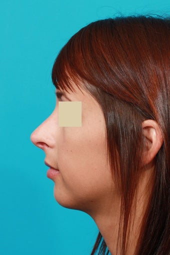 Open Septorhinoplasty