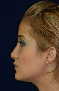 Rhinoplasty and Septoplasty