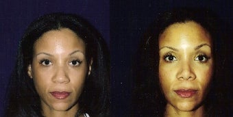 Rhinoplasty and Septoplasty