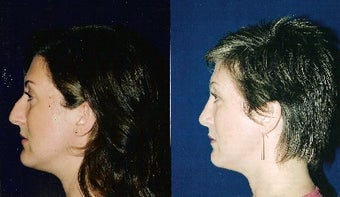 Rhinoplasty and Septoplasty