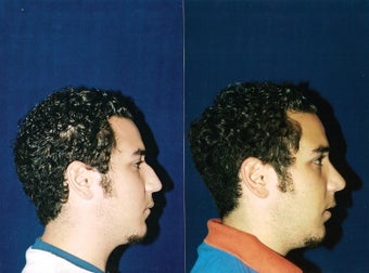 Rhinoplasty and Septoplasty