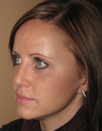 rhinoplasty/nose job