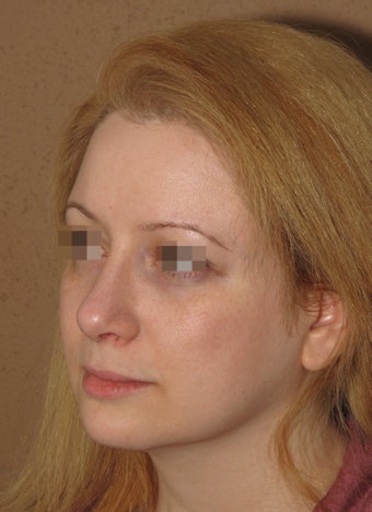 2 weeks after result of rhinoplasty/septoplasty