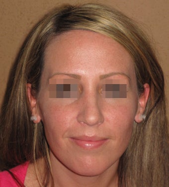 Septoplasty, nose job rhinoplasty