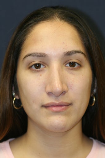 Rhinoplasty and Septoplasty