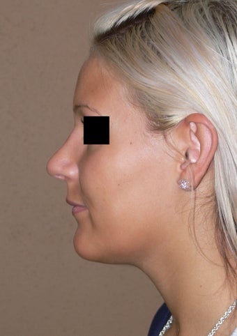 Nose job - rhinoplasty