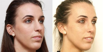 Septoplasty with rhinoplasty