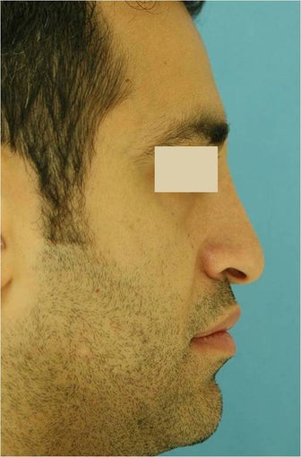 Rhinoplasty, Septoplasty